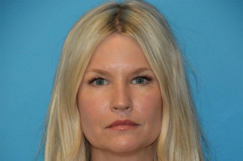 Utah Facial Surgical Arts lip lift after — West Jordan, UT