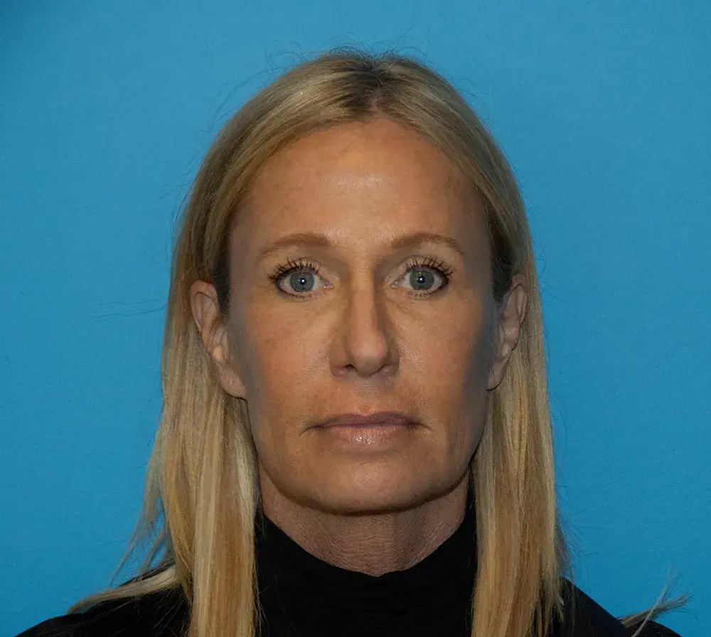 Utah Facial Surgical Arts brow lift after — Salt Lake City, UT
