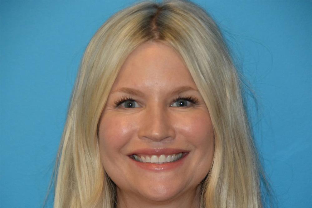 Utah Facial Surgical Arts lip lift after — West Jordan, UT