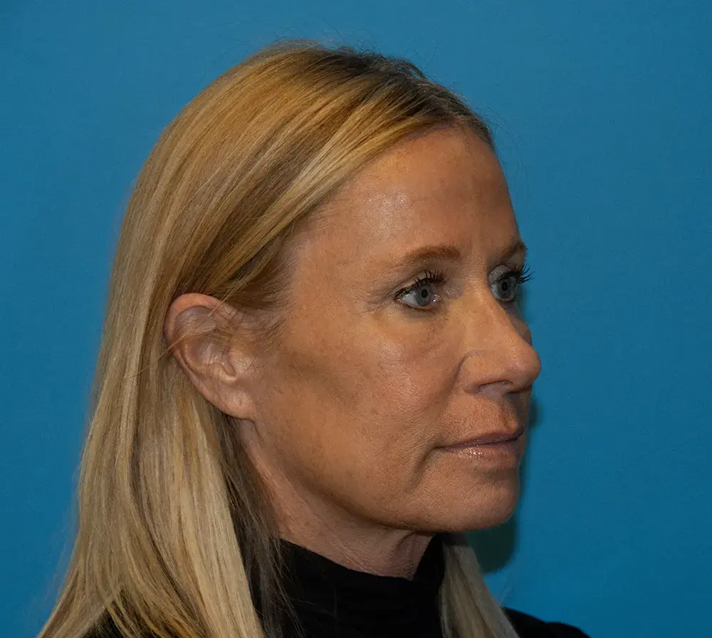 Utah Facial Surgical Arts brow lift after — Salt Lake City, UT