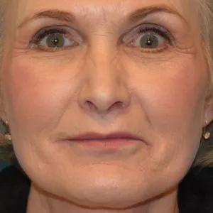 Utah Facial Surgical Arts lip lift after — Salt Lake City, UT