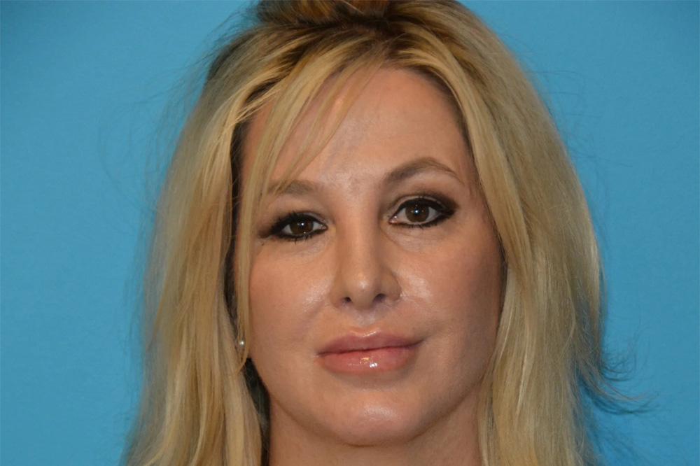 Utah Facial Surgical Arts lip lift after — West Jordan, UT