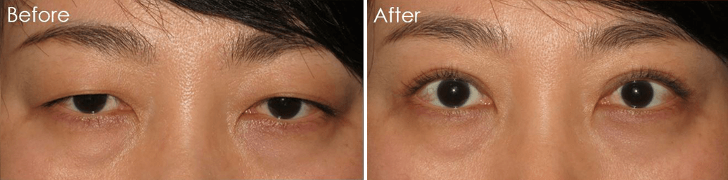 Christopher Lo, MD - Irvine Eyelid Surgery eyelid lift result — Irvine, CA