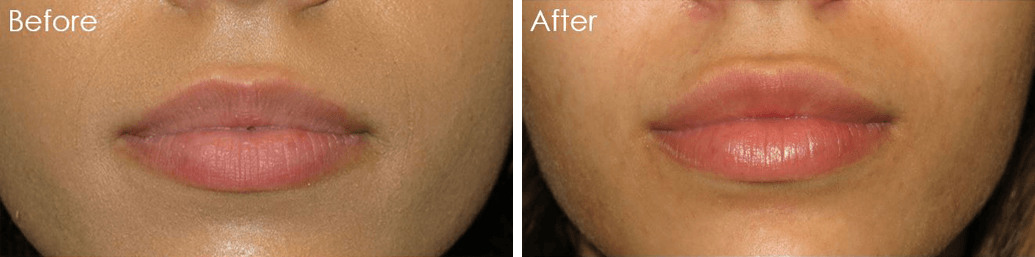 Christopher Lo, MD - Irvine Eyelid Surgery lip filler result — Irvine, CA