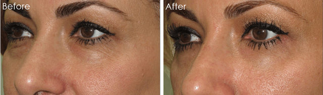 Blepharoplasty result at Christopher Lo, MD - Irvine Eyelid Surgery in Irvine, CA
