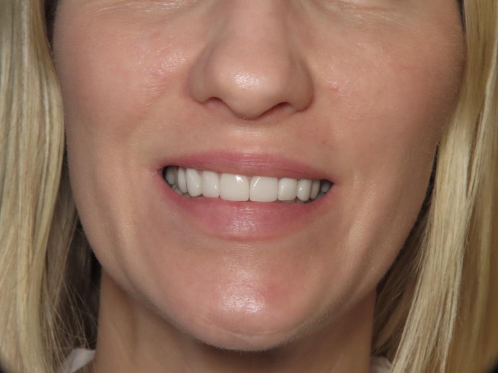 Strempek Dental Arts smile makeover after — Dallas, TX