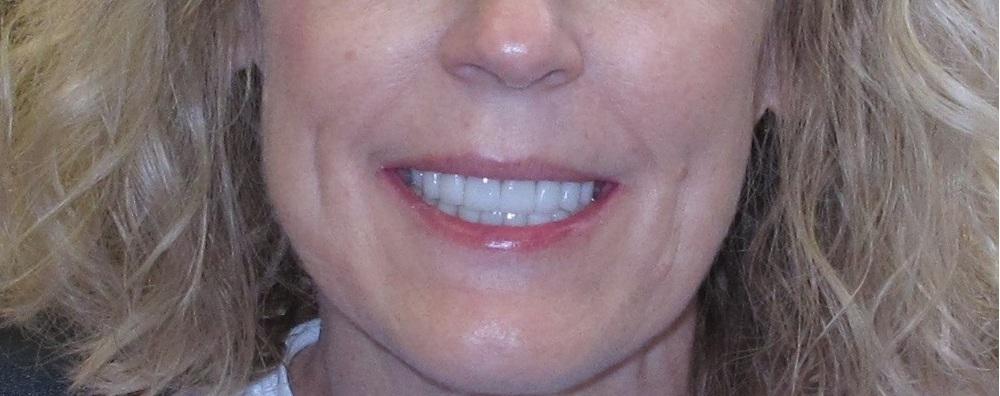 Strempek Dental Arts smile makeover after — Dallas, TX