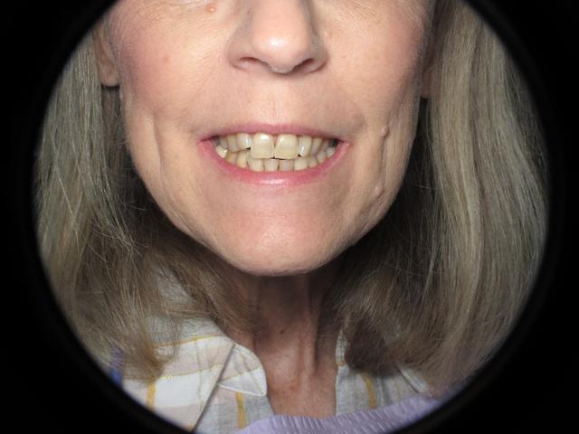 Smile Makeover before at Strempek Dental Arts in Dallas, TX