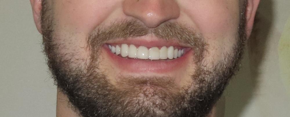 Strempek Dental Arts smile makeover after — Dallas, TX