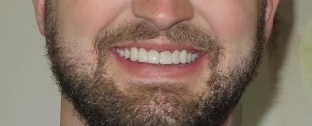 Smile Makeover after at Strempek Dental Arts in Dallas, TX