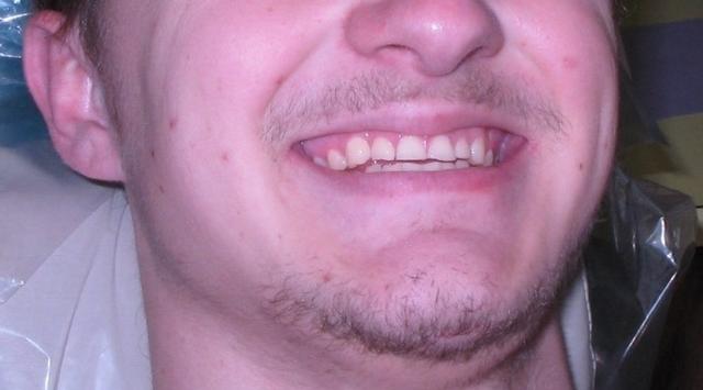 Smile Makeover before at Strempek Dental Arts in Dallas, TX
