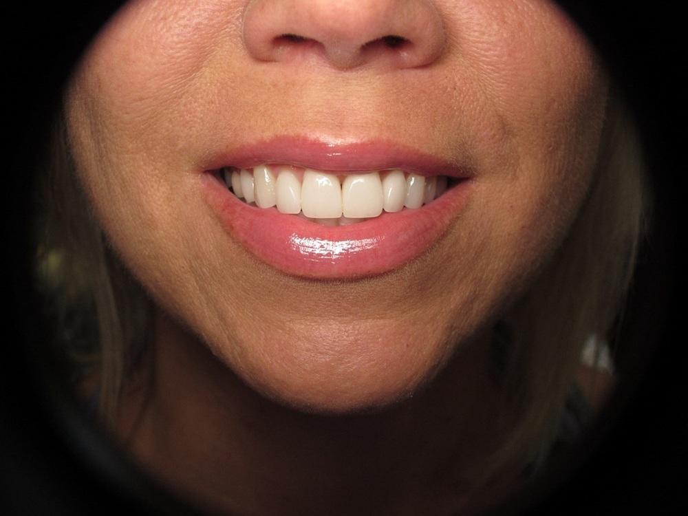 Strempek Dental Arts smile makeover after — Dallas, TX
