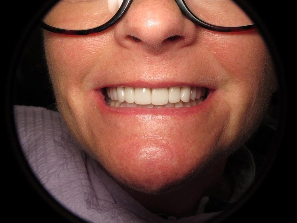 Strempek Dental Arts smile makeover after — Dallas, TX
