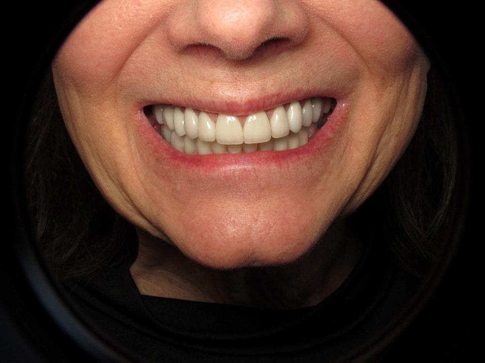 Strempek Dental Arts smile makeover after — Dallas, TX