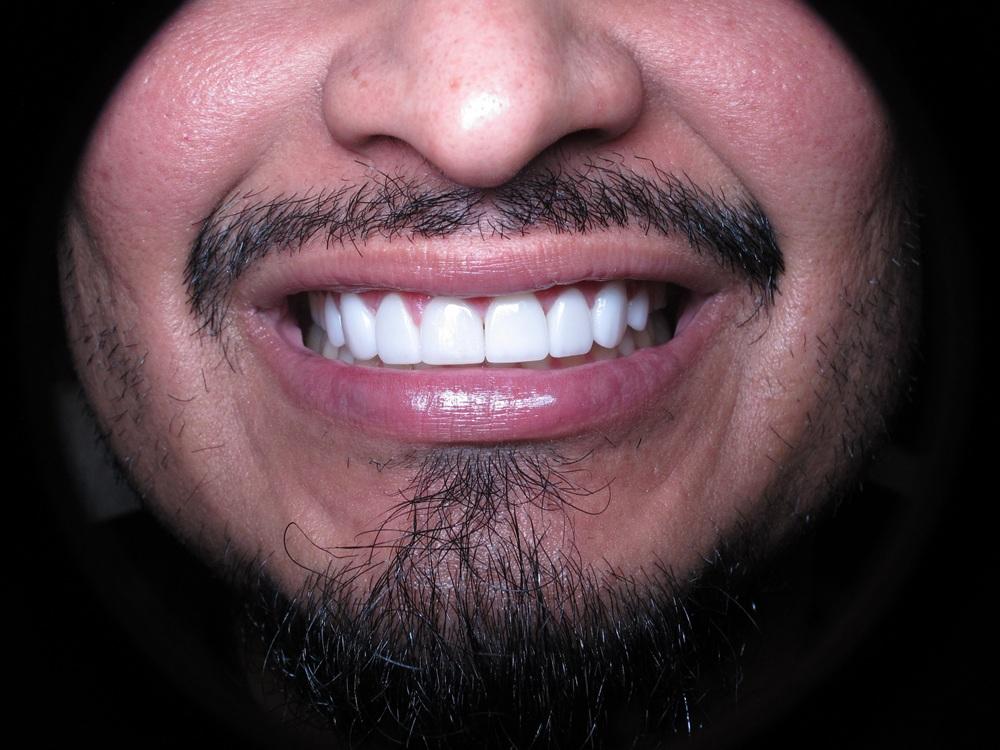 Strempek Dental Arts smile makeover after — Dallas, TX