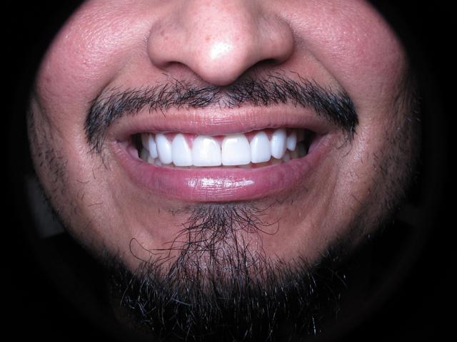 Smile Makeover after at Strempek Dental Arts in Dallas, TX