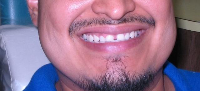 Smile Makeover before at Strempek Dental Arts in Dallas, TX
