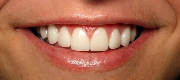 Strempek Dental Arts smile makeover after — Dallas, TX