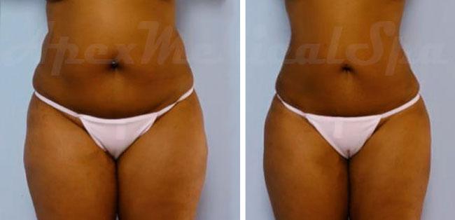 Apex Medical Spa liposuction result — Las Vegas, NV