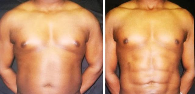 Liposuction result at Apex Medical Spa in Las Vegas, NV