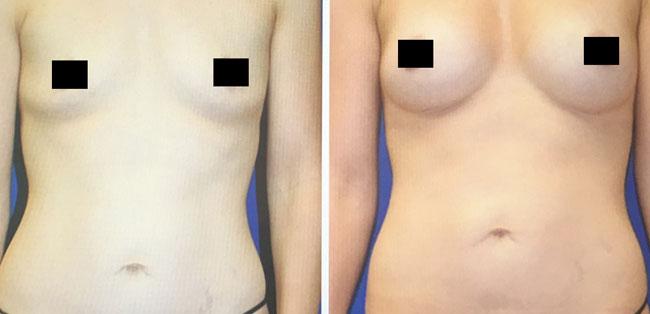 Apex Medical Spa fat transfer result — Las Vegas, NV