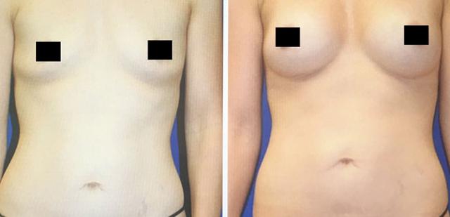 Fat Transfer result at Apex Medical Spa in Las Vegas, NV