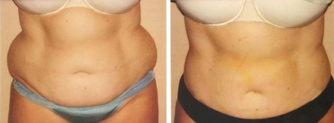 Apex Medical Spa liposuction result — Las Vegas, NV