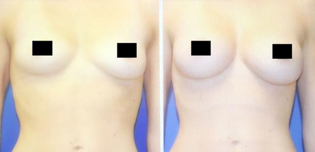 Fat Transfer result at Apex Medical Spa in Las Vegas, NV