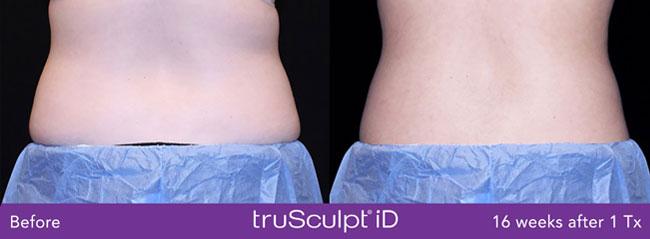 Apex Medical Spa result — Las Vegas, NV