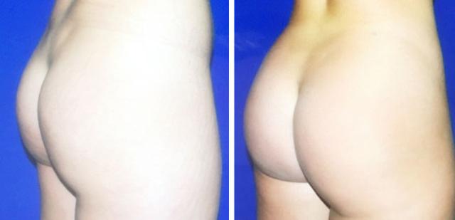 Fat Transfer result at Apex Medical Spa in Las Vegas, NV