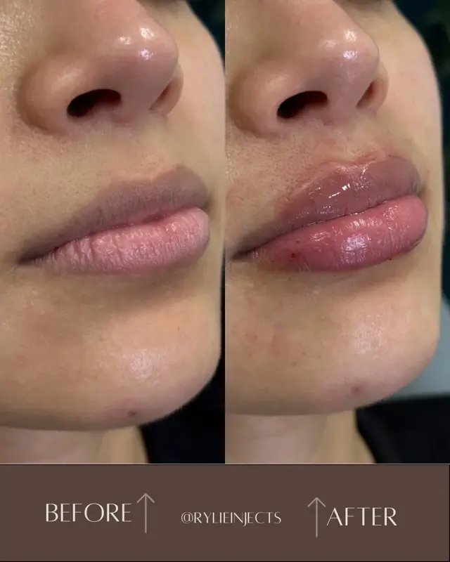 Lip Filler result at Rylie Injects in Lehi, UT