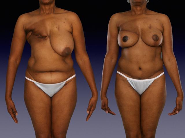 Breast Augmentation result at Center for Restorative Breast Surgery in New Orleans, LA