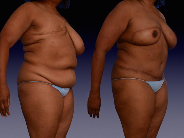 Breast Augmentation result at Center for Restorative Breast Surgery in New Orleans, LA