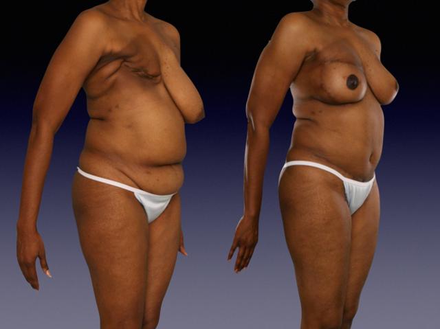 Breast Augmentation result at Center for Restorative Breast Surgery in New Orleans, LA