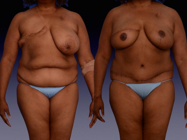 Breast Augmentation result at Center for Restorative Breast Surgery in New Orleans, LA