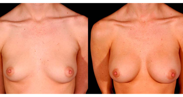 Breast Augmentation result at Amaira Med Spa & Surgical in Fort Lauderdale, FL