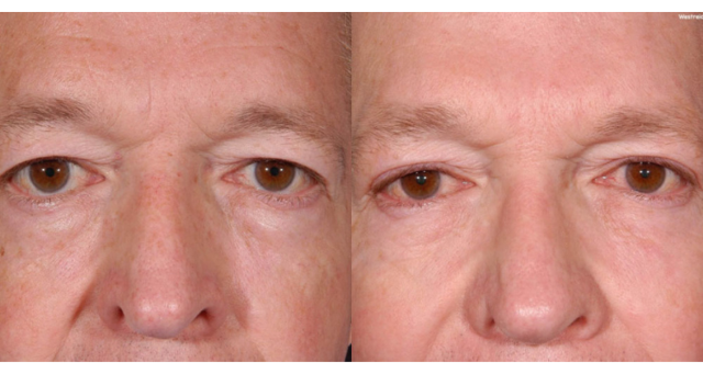 Blepharoplasty result at Amaira Med Spa & Surgical in Fort Lauderdale, FL