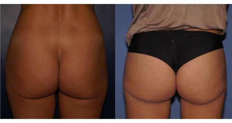 Amaira Med Spa & Surgical bbl result — Fort Lauderdale, FL