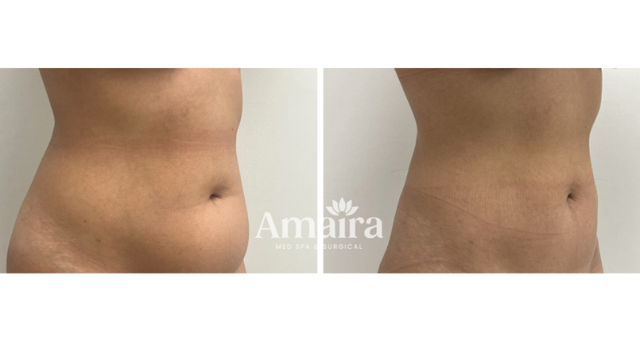 Liposuction result at Amaira Med Spa & Surgical in Fort Lauderdale, FL