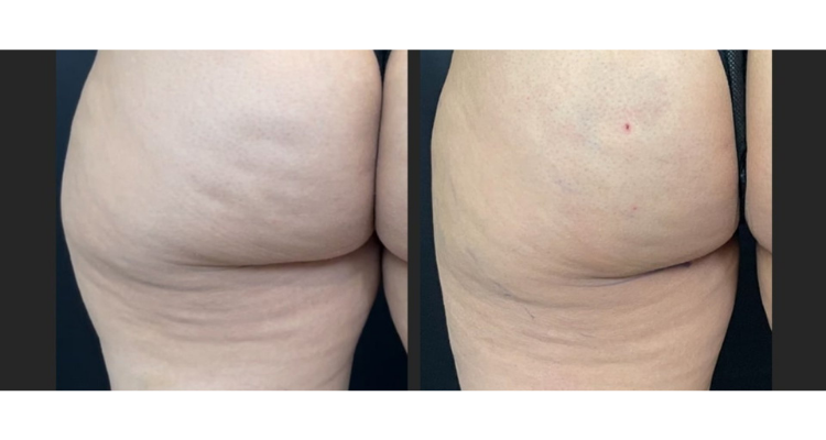 Amaira Med Spa & Surgical bbl result — Fort Lauderdale, FL
