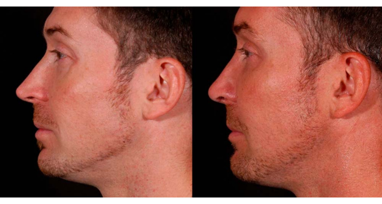 Amaira Med Spa & Surgical rhinoplasty result — Fort Lauderdale, FL