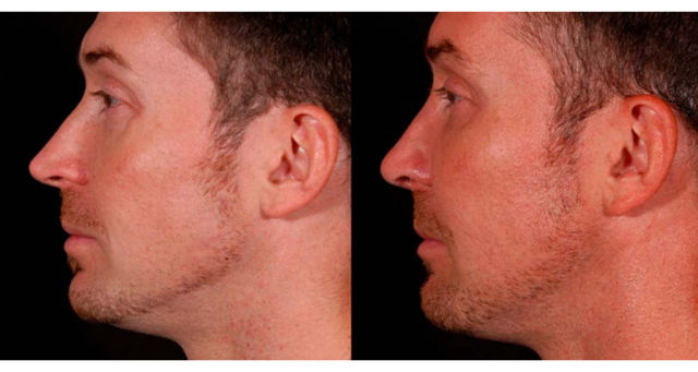 Rhinoplasty result at Amaira Med Spa & Surgical in Fort Lauderdale, FL