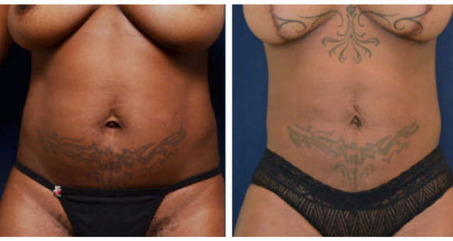 Tummy Tuck result at Amaira Med Spa & Surgical in Fort Lauderdale, FL