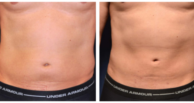 Tummy Tuck result at Amaira Med Spa & Surgical in Fort Lauderdale, FL