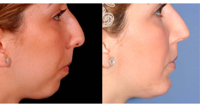 Rhinoplasty result at Amaira Med Spa & Surgical in Fort Lauderdale, FL