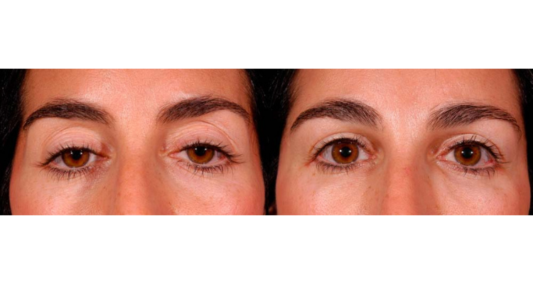 Amaira Med Spa & Surgical blepharoplasty result — Fort Lauderdale, FL