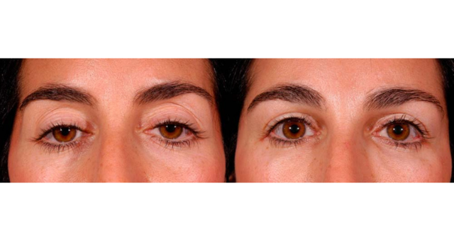 Blepharoplasty result at Amaira Med Spa & Surgical in Fort Lauderdale, FL