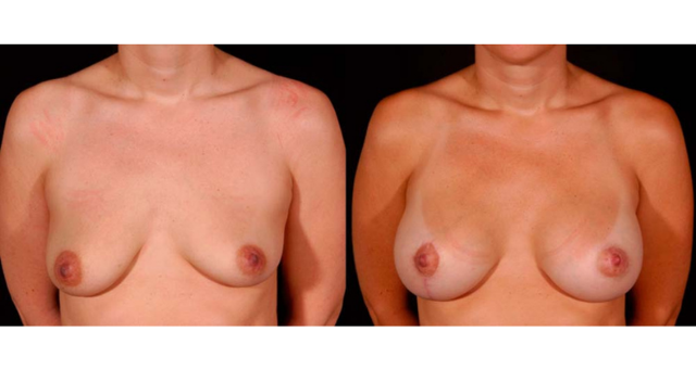 Breast Augmentation result at Amaira Med Spa & Surgical in Fort Lauderdale, FL