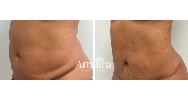 Liposuction result at Amaira Med Spa & Surgical in Fort Lauderdale, FL