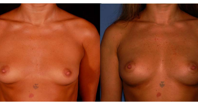 Breast Augmentation result at Amaira Med Spa & Surgical in Fort Lauderdale, FL